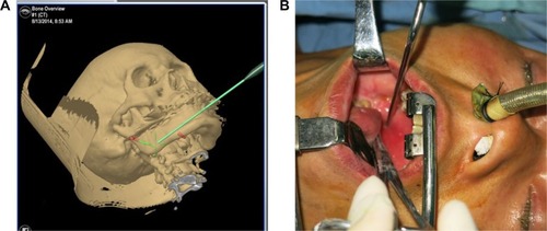 Figure 2 Intraoperative application of surgical navigation to orient the elongated SP.
