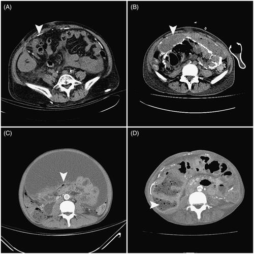 Figure 3. Cross-sectional abdominal computed tomography images of patients diagnosed with EPS. Note the peritoneal calcification (A, arrow), peritoneal thickening surrounding the ascites (B, arrow), bowel tethering (C, arrow), and bowel dilation (D, arrow) in the patients who discontinued peritoneal dialysis.