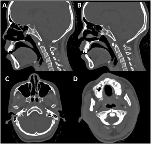 Figure 1 Sagittal (A and B) and axial (C) CT images of the paranasal sinuses in bone window settings demonstrate thickening of the vomer (in C), medialization of the pterygoid plates (in C) and membranous bridging of the remaining choanal opening. Minimal retained secretions are seen in the nasal cavities. A lower axial section (D) shows bipartite atlas, in which both anterior and posterior arches of C1 are unfused.