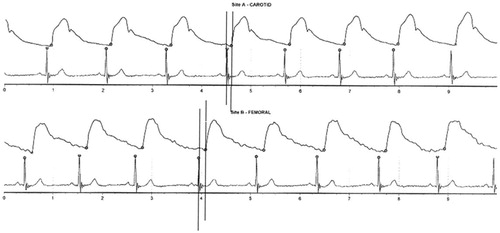 Figure 3. Carotid and femoral pulse waveforms, pulse wave velocity and central clinical parameters obtained by applanation tonometry.