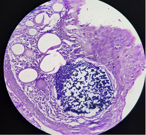 Figure 2 Numerous sporangia within conjunctival submucosa with bursting of sporangia and trans-epithelial migration of spores.