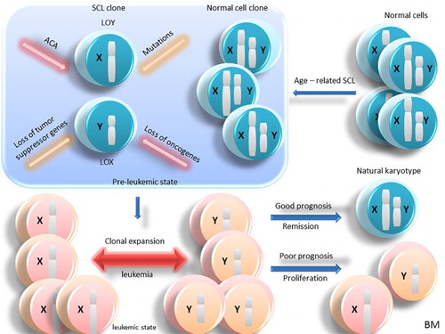 Figure 1. Age-related SCL in normal BM cells and the leukemogenesis. In normal cells, with the effect of aging in BM, the cells gradually experience age-related SCL. So, two types of clones as normal cells and SCL ones are created. With the effect of a mutation, ACA, loss of tumor suppressor genes and oncogenes, the pre-leukemic state is created, which will ultimately lead to the clonal expansion and leukemia in which SCL can be seen in all the leukemic cells in BM. In this case, depending on the loss of genes involved in sexual chromosomes, ACA, and other factors, benign or malignant leukemia can be created. If leukemia is benign, the cells return to their normal karyotype and if it is malignant, the cells will continue to proliferate. Abbreviation: BM: bone marrow; SCL: sex chromosome loss; ACA: additional chromosome abnormality; LOY: loss of chromosome Y; LOX: loss of chromosome X.