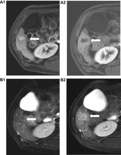 Figure 7 Axial MRI of the liver ((A1, A2) post contrast, (B1, B2) T2WI) showing segment VI HCC before and after treatment with Sorafenib. Notice in panel (A) post-treatment MRI (A2) shows HCC with decrease central enhancement (comparing to pre-treatment image (A1)) with geographical perilesional enhancement go with perfusion changes. Notice in image (B2) the increase in T2WI signal intensity (compared to (B1)) as a part of post-Sorafenib changes.