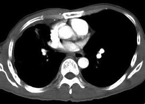 Figure 3.  Computed Tomography of the thorax showing remnant of the right middle lobe mass and a right pleural effusion (4 months after treatment with erlotinib).