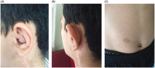 Figure 1. (A, B) A neurofibroma filling the external ear canal and pushing the auricle forward. C: Coffee-coloured stains on the skin.