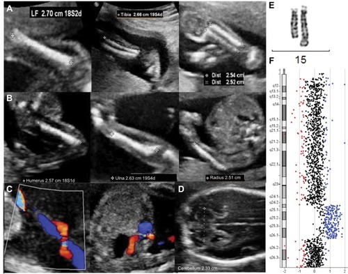 Figure 1 Morphologic ultrasonogram of a 21+1-week male fetus with 19+5-week-ultrasound parameters.