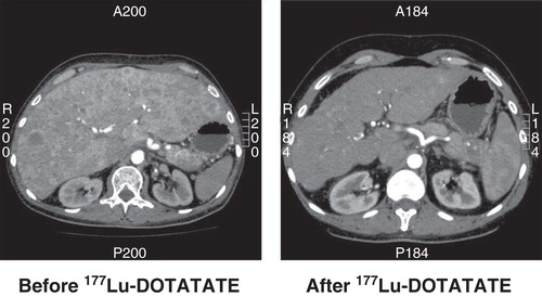 Figure 2. CT scan of a patient with a non-functioning pancreatic NET before and 6 months after treatment with four cycles of 177Lu-DOTATATE. The size of the liver is reduced and almost all metastases have disappeared.