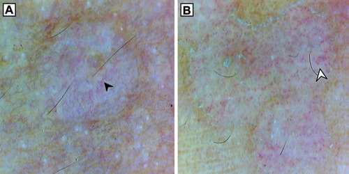 Figure 4 Dermoscopy (original magnification 10×) showing different vascular patterns in pityriasis versicolor. (A) Linear branching vessels (black arrowhead). (B) Dotted vessels (white arrowhead). Note perilesional hyperpigmentation in (A), peripheral scaling in (B) and inconspicuous ridges and furrows in both (A) and (B).