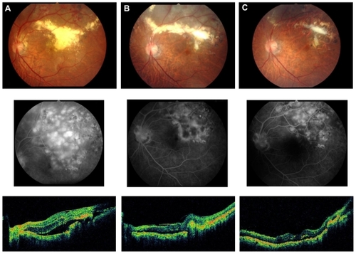 Figure 1 Color fundus photograph (upper panel), corresponding fluorescein angiography (middle), and optical coherence tomography (lower) of the left eye in patient #1 with adult Coats’ disease: (A) at the initial visit; (B) 1 year after treatment of retinal photocoagulation; (C) 11 years after treatment.