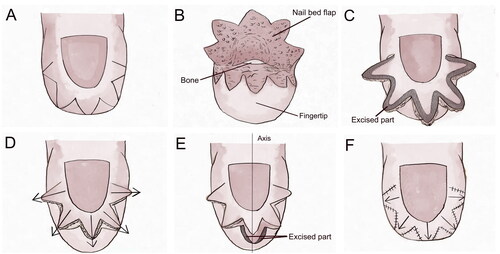 Figure 2. Schematic representation of the surgical procedure. (A) Continuous W-shaped incisions were made on the pulp of the finger/toe approximately 2–3 mm away from the nail bed. (B) The nail bed flap was meticulously dissected. (C) Skin and soft tissue excess were excised along the shaded area. The width of the shaded area was adjusted based on tension and blood circulation. (D) Stretching the trimmed nail bed flap toward the periphery. (E) Appropriate removal of fingertip soft tissue was performed to adjust the longitudinal axis of the nail bed flap. (F) The incision was sutured to expand the nail bed.