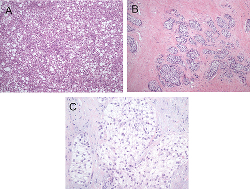 Figure 4 Major subtypes of HCC with metabolic risk factors. (A) Steatohepatitic HCC: The tumor shows macrovesicular steatosis, ballooning, Mallory–Denk bodies, and inflammation (hematoxylin and eosin stain, original magnification ×100). (B) Scirrhous HCC: The tumor nests and single tumor cells are present in a dense desmoplastic background (hematoxylin and eosin stain, original magnification ×200). (C) Clear-cell HCC: The tumor cells have glycogen-rich clear cytoplasm (hematoxylin and eosin stain, original magnification ×200).
