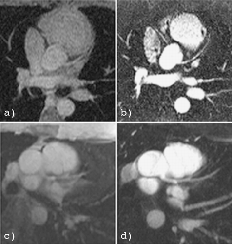 Figure 1. LAD images from two healthy volunteers using a whole body coil (a, b) and a cardiac phased array coil (c, d), respectively. a). Pre‐contrast image. b). Post‐contrast image of the same volunteer using body coil. c). Pre‐contrast image of another volunteer using phased array coil. d). Post‐contrast image using phased array coil. Note CNR and vessel delineation were consistently improved in the contrast agent first‐pass images.