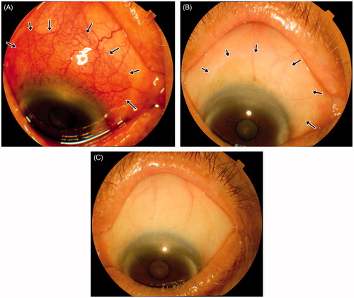FIGURE 1. Slit-lamp biomicroscopy appearance of right eye (A) at presentation, and (B) 6 months after treatment. (C) Slit-lamp biomicroscopy appearance of left eye.
