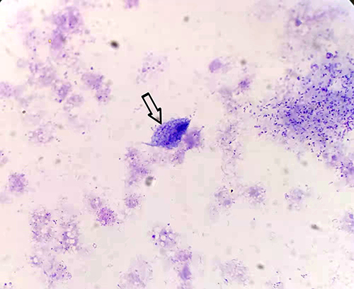 Figure 2 Against a background of necrotic fragments, a pear-shaped body with flagella was visible, containing a large dark purple long oval nucleus shaped like a mouse eye, highly suspicious for T. tenax. (indicated by arrow, Richter-Giemsa stain, ×1000).
