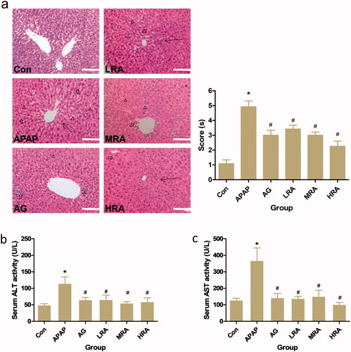 Figure 2. Protective effects of rosmarinic acid on APAP-induced acute liver injury in mice. (a) Histology. Histological examination of liver tissue was performed 24 h after 300 mg/kg APAP administration. Liver tissues were fixed, sectioned at 4 μm thickness, and stained with haematoxylin–eosin (HE). Representative HE (left panel) stained sections of the liver of mice in the control group (Con), APAP group, APAP + ammonium glycyrrhetate group (AG), APAP + RA (10 mg/kg) group (LRA), APAP + RA (20 mg/kg) group (MRA) and APAP + RA (40 mg/kg) group (HRA) (magnification ×200); Histological scores (right panel) were evaluated by an experienced pathologist in a blinded manner under light microscopy (n = 5). Triangles display vacuolization. The arrows represent the necrosis with the abnormal structure of hepatic lobules. The hollow arrows show the mononuclear cell infiltration. (b) Serum alanine aminotransferase (ALT) (n = 10). (c) Serum aspartate aminotransferase (AST) (n = 10). Values are presented as mean ± S.E.M. *p < 0.05 vs. control group. #p < 0.01 vs. APAP group.