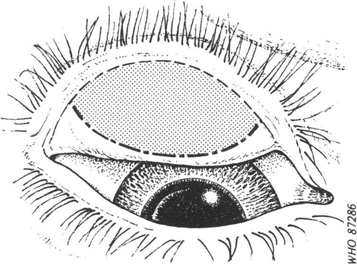 Figure 1. Sketch of everted upper eyelid, showing the area (shaded) of the tarsal conjunctiva to be examined for assessment of trachomatous inflammation—follicularCitation8 (© World Health Organization, reproduced with permission).