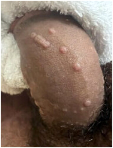 Figure 7. Monkeypox. Umbilicated papules on the penile shaft. Reprinted with permission from: Vallée et al. [Citation96], with permission from Elsevier.