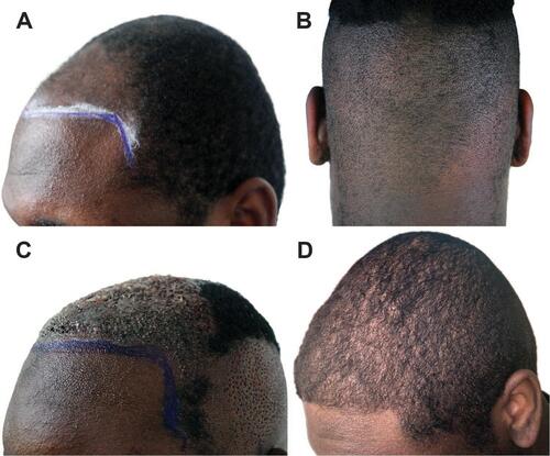 Figure 13 Case 2, a 26-year-old African American male undergoing FUE transplantation with the all-purpose FUE device set at moderate torque, oscillation mode, and an 18-G punch. (A) Frontal area before transplantation; (B) donor area showing chaotic hair exit angles; (C) the frontal area soon after grafting and the head donor area soon after extractions; and (D) results at 11 months after surgery.