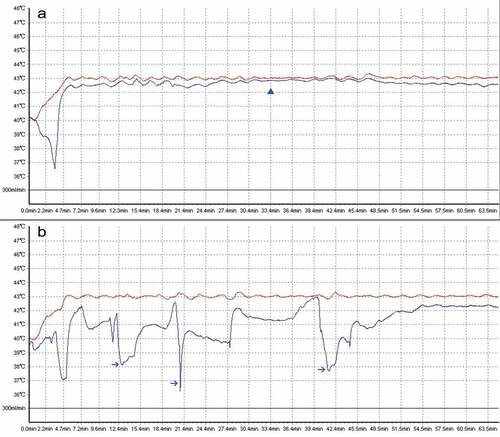 Figure 1. The demonstration of a thermal homogeneity during HIPEC. A. A typical stable perfusion temperature was obtained. The actual temperature in outflow drain (blue curve) almost equals with the setting temperature in inflow drain (red curve). The blue triangle indicates a stable perfusion temperature; B. A typical unstable perfusion temperature was observed by real-time monitoring out-drain temperature. Those blue arrows indicate extensive fluctuations beyond 1°C to default 43°C.