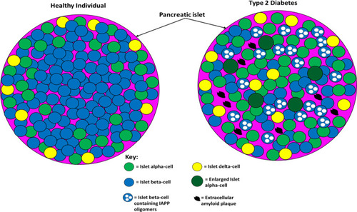 Figure 4 The difference between pancreatic islet architecture in healthy individuals and individuals with T2D. In healthy individuals, beta-cells are situated centrally and peripherally and are the most abundant cell type (~70%). Non-beta cells are found in the periphery of the islets and constitute ~30% of the cell population (20% alpha-cell and 10% other cell types). Islet architecture is altered in T2D with a greatly diminished population of beta-cells, more alpha-cells, more delta-cells, migration of alpha- and delta-cells into the centre, extracellular amyloid plaque deposits, intracellular IAPP oligomers in beta-cells, and enlarged alpha-cells. The altered architecture in T2D produces different intra-islet paracrine signalling which impairs metabolic homeostasis. This figure and information in its legend are with data adapted from Brereton et al.Citation141