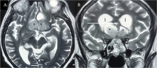 Figure 3 (A) Axial; (B) Coronal; T2 Magnetic Resonance Images depicting the residual tumour (<60%) at 3 months of follow-up from the subtotal resection via the endonasal transsphenoidal approach prior to initiation of radiotherapy. *: Residual tumour in the lateral ventricles; 1: Lateral ventricles; 2: Third ventricle; 3: Fat graft placed during the transsphenoidal approach into the tumour.