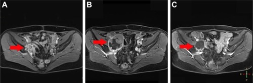 Figure 3 Pelvic MRI showing the right side pelvic cavity metastasis.