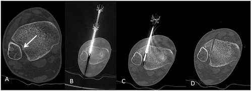 Figure 1. Computed tomography axial scans of a patient with symptomatic intra-articular osteoid osteoma (biopsy proven). (A) White arrow illustrates the nidus (5 mm in diameter) of an intra-articular osteoid osteoma in the tibio-fibular joint. (B) Once inside the nidus, coaxially through the OnControl trocar the bone biopsy needle is inserted for sampling. (C) Post biopsy, the radiofrequency electrode is coaxially inserted and ablation session is performed with osteoid osteoma protocol according the manufacturer’s guidelines. (D) Post-ablation scan illustrating the access through normal bone ending inside the nidus of the osteoid osteoma.