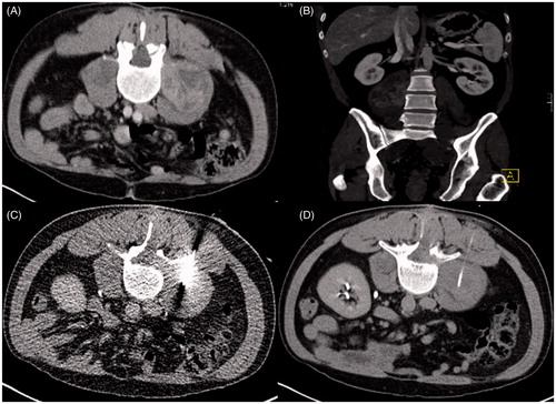 Figure 2. Closed-tip catheter placement in a 41-year old mn with a retroperitoneal malignant peripheral nerve sheath tumour (MPNST) (A) Contrast-enhanced planning CT scan shows the extent of the tumour in right psoas muscle. (B) Coronal reconstruction. (C) Intra-interventional CT fluoroscopy image. Final position of the closed-tip catheter.