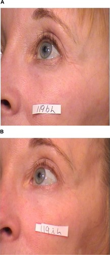 Figure 4 Periocular rhytides before (A) and after three nonablative fractionated erbium (1,550 nm) laser treatments (B).