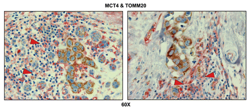 Figure 10 Tumor-associated inflammatory cells are glycolytic. Paraffin-embedded sections of human breast cancer primary tumors were immunostained with antibodies directed against MCT4 (red color) and TOMM20 (brown color). Slides were then counterstained with hematoxylin (blue color). Note that tumor-associated inflammatory cells (red arrowheads) are MCT4(+) and TOMM20(-), consistent with a glycolytic phenotype. In contrast, TOMM20 is strongly associated with the primary breast cancer cells. Two representative images are shown. Original magnification, 60x.