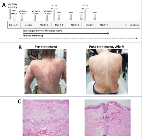 Figure 1. Regression of cutaneous metastases after 2 doses of p53MVA vaccine and pembrolizumab. (A) The treatment schema: p53MVA vaccine and pembrolizumab were given concurrently every 3 weeks for 3 cycles. Pembolizumab alone was then administered every 3 weeks for an additional 4 doses. (B) Patient's skin pre- and 9 weeks post-treatment: before treatment (left) diffuse skin metastases covering 50% of the body area were visible. After 2 cycles of combined therapy (right) significant improvement was noted. (C) Pre- and post-treatment histopathology: pre-treatment skin punch biopsy (left) shows tumor nests composed of pleomorphic cells present predominantly within lymphovascular spaces. Post-treatment biopsy (right) demonstrates mild fibrosis and superficial perivascular lymphocytic infiltrate with no residual malignant cells present.