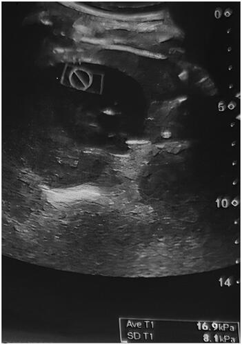 Figure 1. Sagittal supersonic shear imaging elastography image.