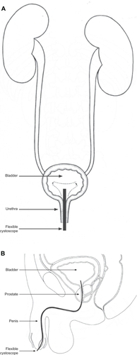 Figure 1 Cystoscopy. (A) Female. (B) Male.