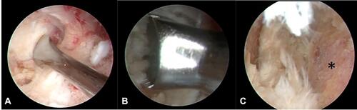 Figure 3 (A) Annulotomy using an annular cutter. (B) Preparation of endplate. (C) Endplate removal completed (asterisk).