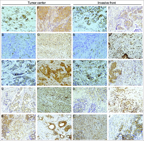 Figure 1. Human mammary carcinomas contain tumor stromal cells expressing metalloproteases and their inhibitors. Representative pictures of mammary cancer patient tissue array immunostaining for the different matrix metalloproteases (MMPs) and tissue inhibitors of metalloproteases (TIMPs) analyzed in breast cancer patients (200X), both at tumor center and at invasive front. (A) MMP-1, (B) MMP-2, (C) MMP-7, (D) MMP-9, (E) MMP-11, (F) MMP-13, (G) MMP-14, (H) TIMP-1, (I) TIMP-2 and (J) TIMP-3.