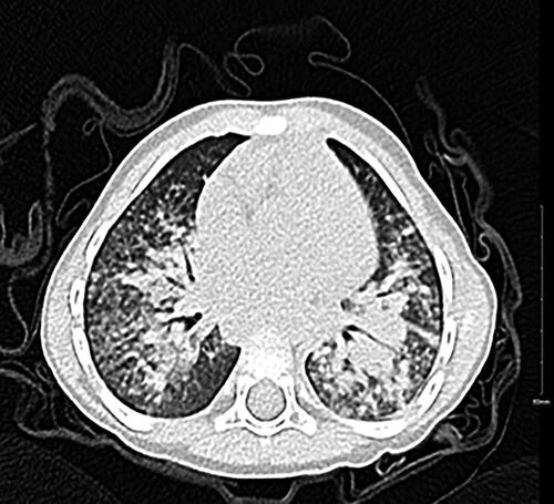 Figure 2. Chest CT scan upon worsening of patient status on day 14 of total illness.