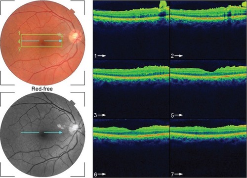 Figure 7 Serial horizontal optical coherence tomography scans demonstrate rupture of the epiretinal membrane (ERM) temporal to fovea with retraction of remaining ERM nasally and return of the normal foveal contour.