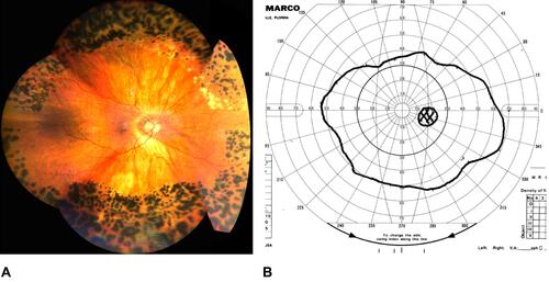 Figure 5 (A) Fundus image of the daughter’s right eye after completed OSC/SS laser prophylaxis. Visual acuity is 20/30 (as preoperatively) corrected with −20.25 +3.75 × 091. (B) Visual field of the right eye post OSC/SS.