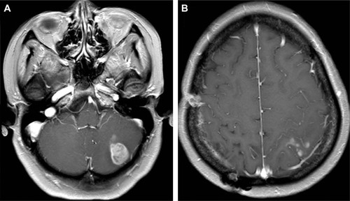 Figure 2 MRI during the second relapse for patient 1.