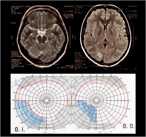 Figure 1. MRI and campimetry. MRI showed a loss of volume in the right occipital-temporal cortex, and a hyperintense lesion located in the cuneus gyrus of the right occipital lobe. In the left superior image, the T2 weighted MRI shows the dorsal extension of the lesion, reaching the medial parietal lobe. In the middle superior image, the T2 weighted MRI shows the lesion at the level of the dorsal occipital cortex. In the right superior image, the FLAIR sequence shows the ventral and subcortical extension of the hyperintense lesion. Below: The kinetic perimetry revealed an incomplete left inferior homonymous quadrantanopia.