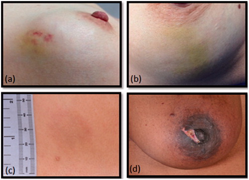 Figure 5. Short-term complications (a, b) two images of ecchymosis at 2 weeks, (c) hyper-pigmentation at 3 months and (d) first-degree skin burn at 2 weeks post-treatment.