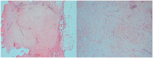 Figure 4. Histopathology of excised fibroadenoma treated with high intensity focused ultrasound (HIFU) showing fibrous scarring on low (left) and high power (right).