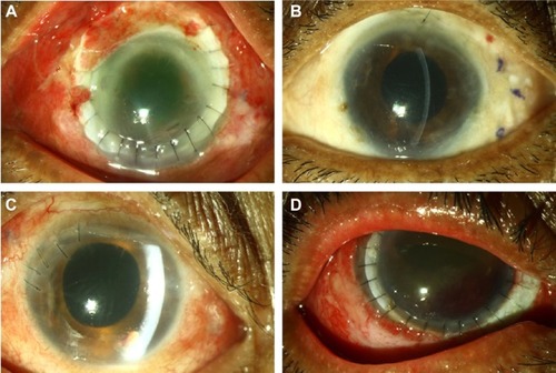 Figure 3 (A–D) Postoperative clinical photographs after resolution of endophthalmitis following vitrectomy, intravitreal antifungal combination therapy (amp-Vo regimen), and adjuvant procedures.