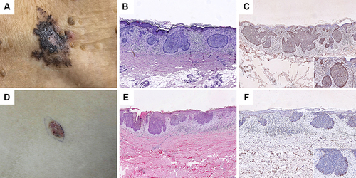 Figure 1 PTCH1 expression at exposed and non-exposed sites. (A) Clinical and ((B); HE×40) histopathological picture of the BCC located in neck. (D) Clinical and ((E); HE×40) histopathological picture of the BCC in back. PTCH1 showed intense staining at exposed sites ((C); IHC×40), while it showed weaker staining at non-exposed sites ((F); IHC×40).