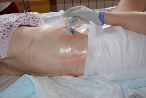 Figure 6 Paravertebral blockade (PVB): a catheter placement to the skin, the bolus of bupivacaine administration in the patient presented.