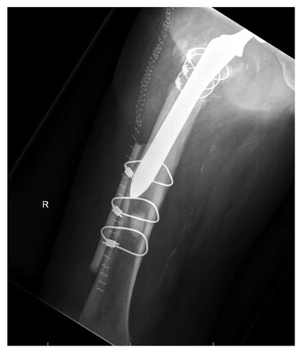 Figure 3: AP radiograph of a periprosthetic femur fracture following cable fixation augmented with a cortical strut femoral allograft.