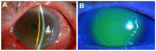 Figure 1 (A) Slit-lamp photograph showing marked conjunctival hyperemia and conjunctival edema in the left eye. (B) There is an extensive corneal epithelial defect covering almost the entire cornea in the left eye.