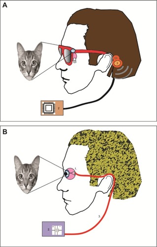 Figure 4 Schematic of a classical prosthesis with a retinal implant (A) and optical sensor prosthesis (B).