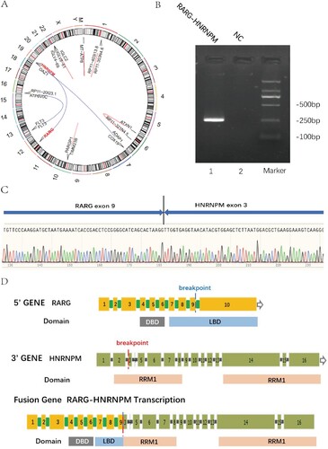 Figure 2. Detection of the RARG/HNRNPM fusion. (A) The circros visualization of the reciprocal RARG/HNRNPM fusion on chromosome. (B) Picture of the amplified fragment on agarose gel. Marker: DNA 2K marker; lane 1: PCR amplicons of RARG-HNRNPM patient; lane 2: NC negative control. (C) Sanger sequencing for RARG-HNRNPM fusion point surrounding base pairs. Verified by NCBI blast, it completely aligned with RARG exon9 and HNRNPM exon3. (D) Overview of the chimeric fusion diagram: the fusion gene structure contained RARG whole DBD (90–155 amino acids), which coincided with two zinc finger motifs (90–110 amino acids and 126–150 amino acids) and two main RNA-recognition motifs (RRMs) of HNRNPM gene.