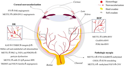 Figure 2. An illustration of RNA methylation regulatory mechanisms responsible for vascular lesions in ocular diseases. The sketched RNA methylation-mediated regulatory mechanisms underlying vascular lesions in corneal neovascularization, DR, ROP, and pathologic myopia are illustrated. DR: diabetic retinopathy; ROP: retinopathy of prematurity; RNV: retinal neovascularization; CNV: choroidal neovascularization.